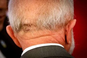 Lula dá entrada em hospital para resolver problema na cabeça