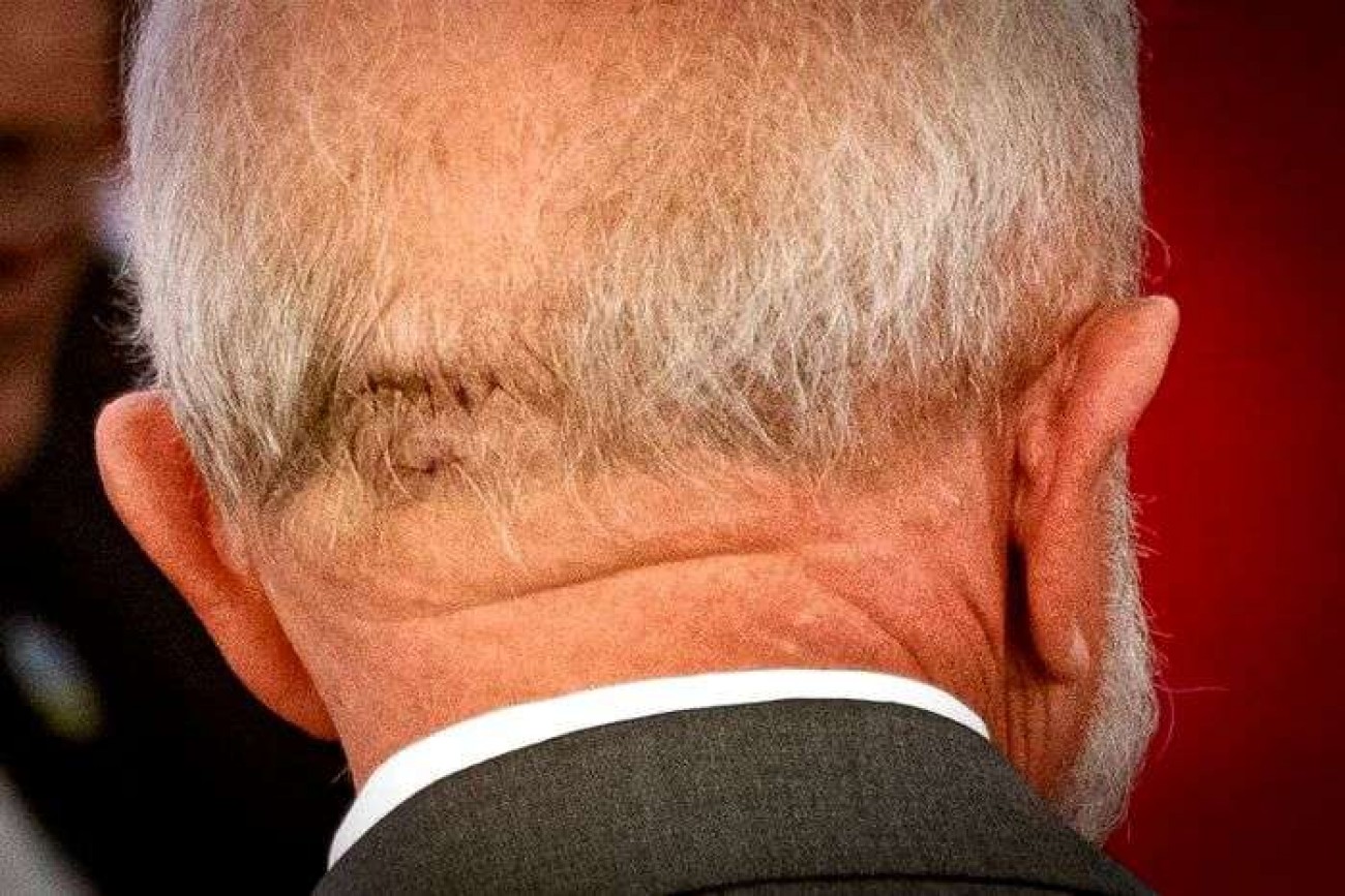 Lula dá entrada em hospital para resolver problema na cabeça